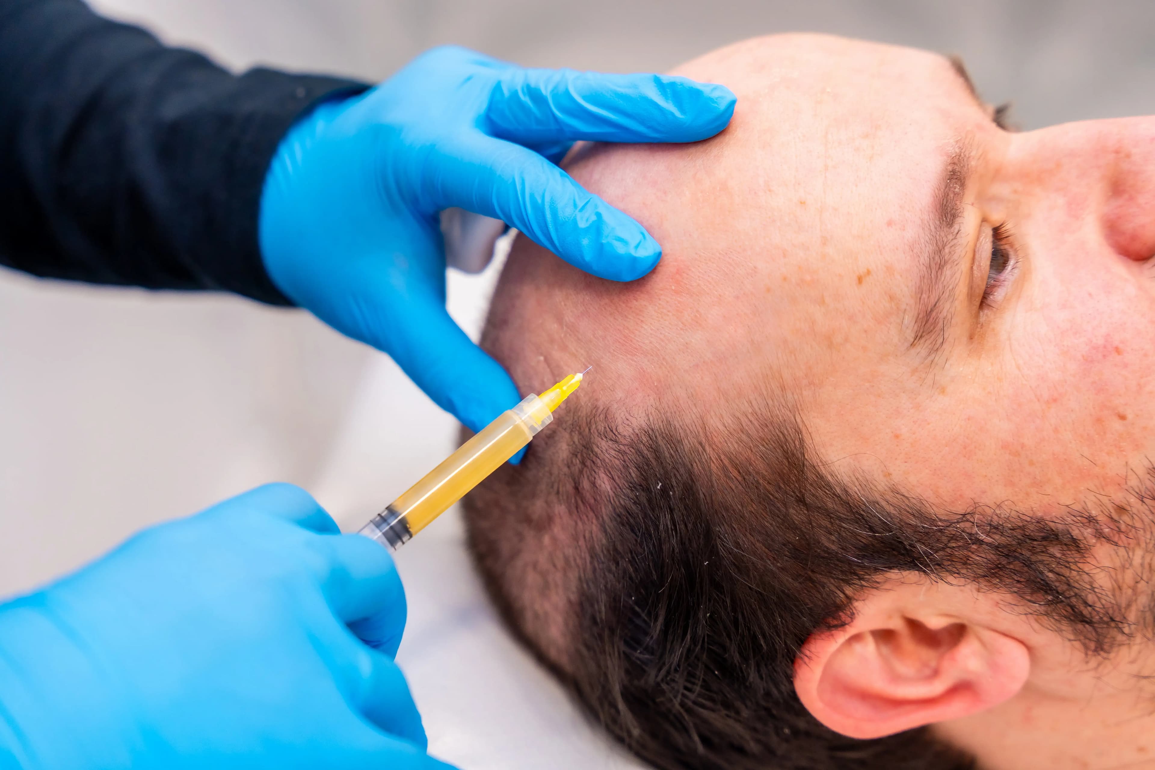 Process Of PRP For Hair Loss- Learn About The Steps In Detail