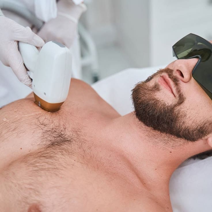 Full Body Laser Hair removal for Men