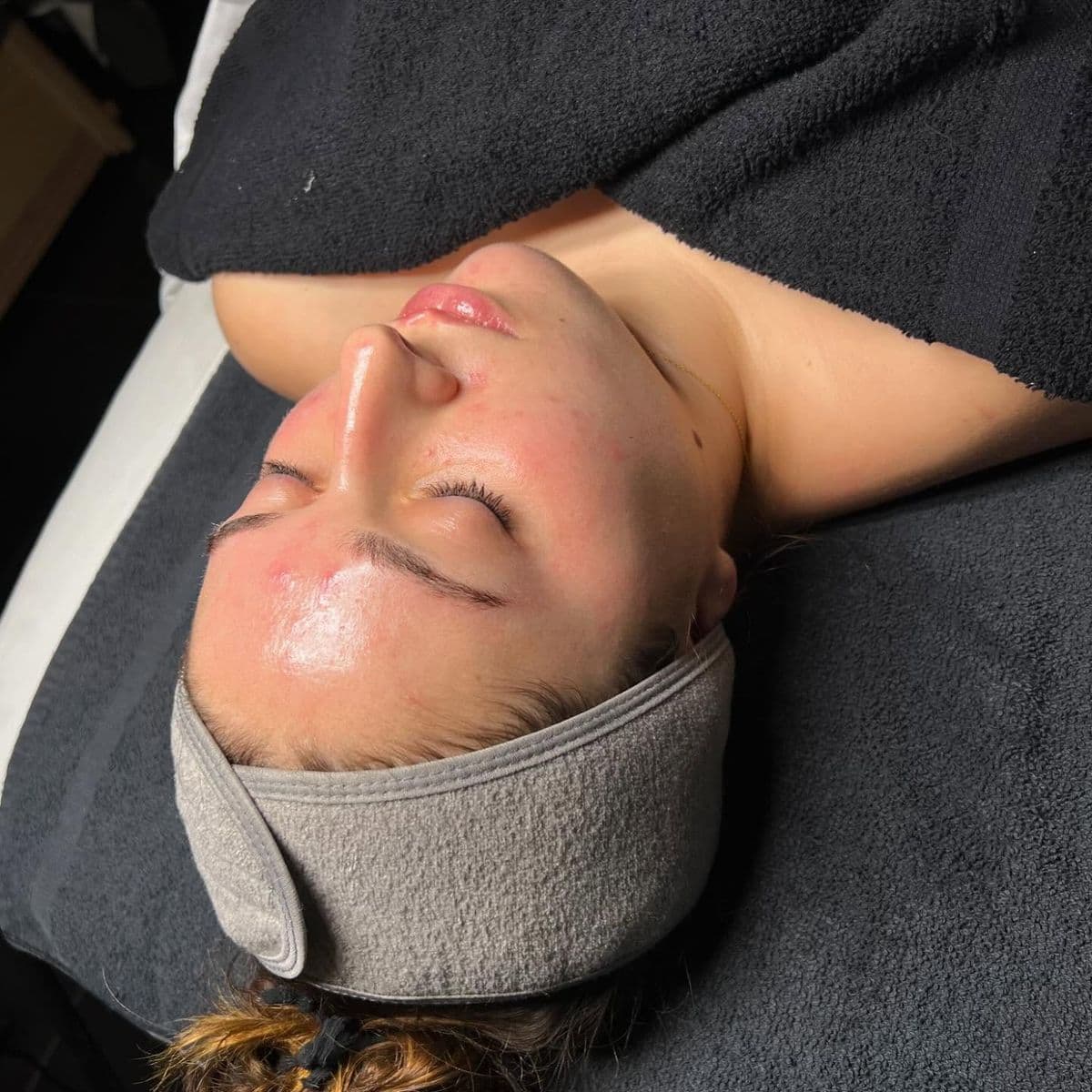 Salicylic Chemical Peel For Women