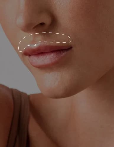 Upper Lip and Chin Laser Hair Reduction