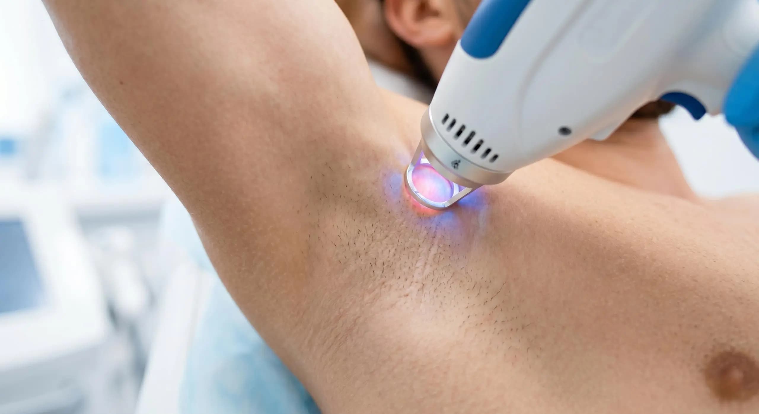 Under Arms Laser Hair Removal for Men 1