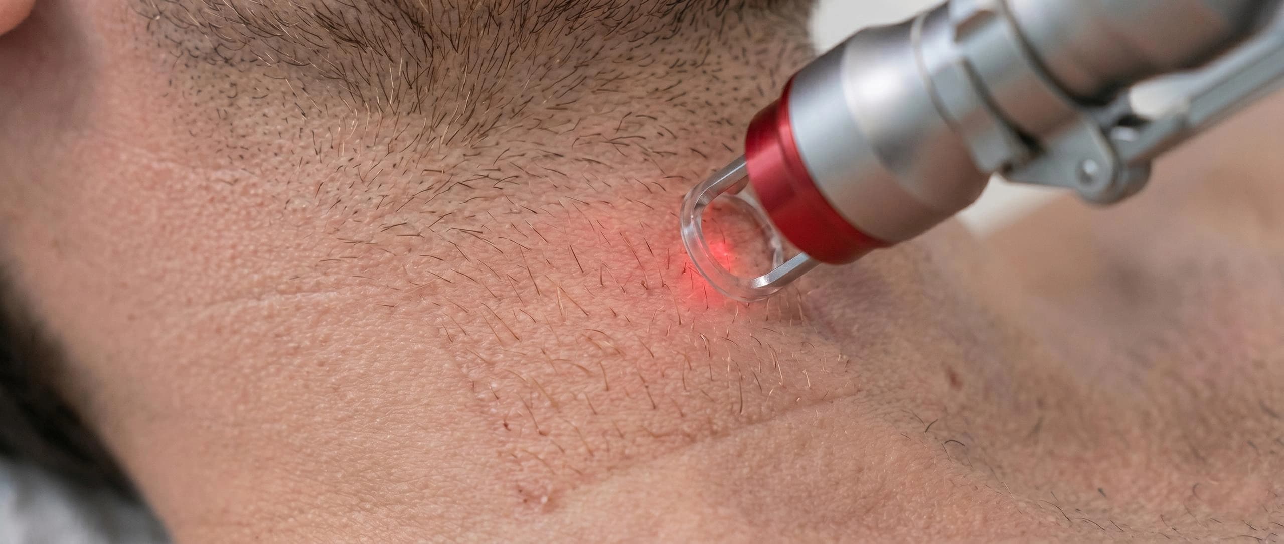 Laser Facials for Men 4