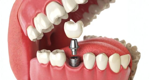 Dental Implant