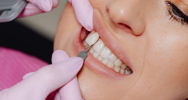 Dental Veneers