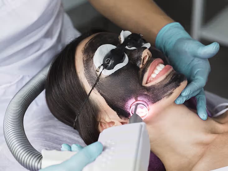Carbon Laser Treatment