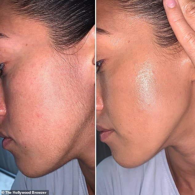 Sidelocks Laser Hair Reduction