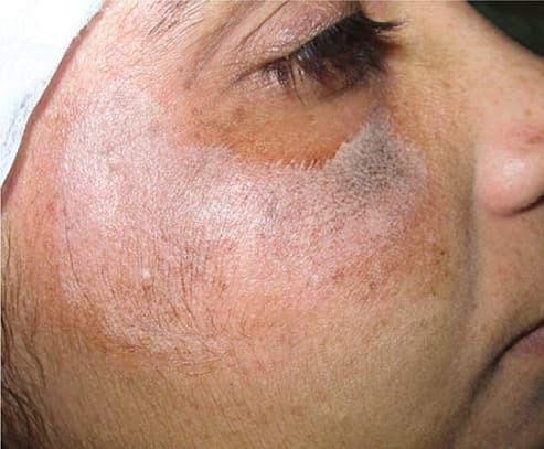 Phenol Peel