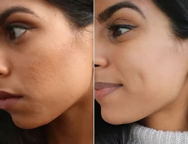 Retinol Peel