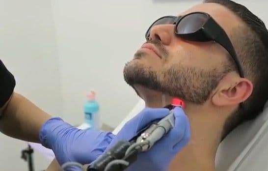 Laser Toning for Men